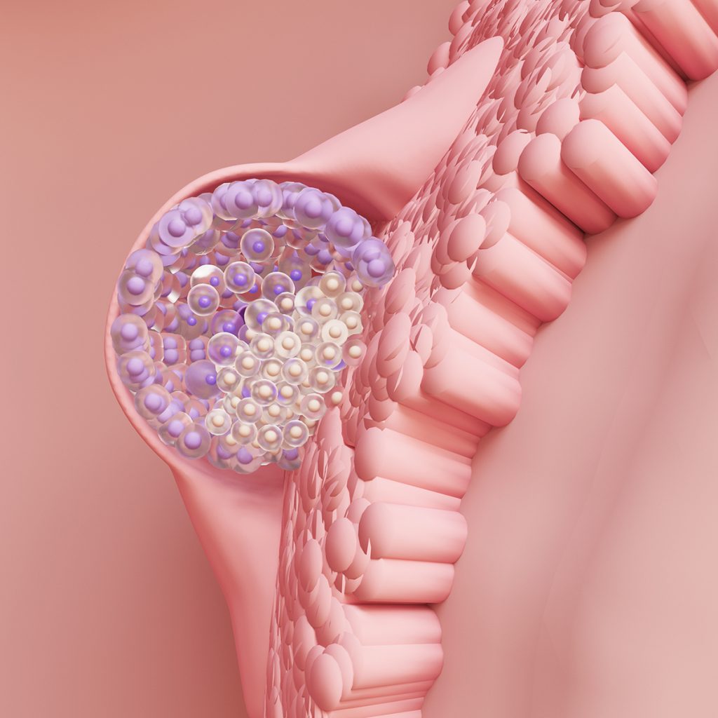 Endometrium receptivity after ovarian rejuvenation